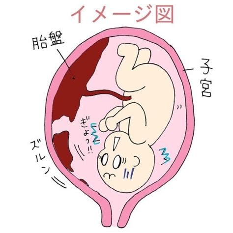 胎盤剝離後期|【医師監修】「常位胎盤早期剥離」は赤ちゃんとママ。